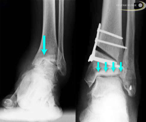 Before and after surgical repositioning of the shinbone (osteotomy)