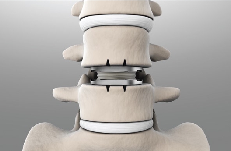 Artificial spinal disc or disc replacement 