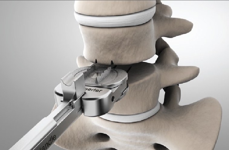 prosthetic intervertebral disc replacement