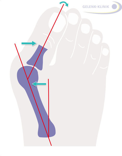 The operation of the Hallux valgus (bunion) corrects the deformity of the big toe, which tilts toward the outside of the foot.