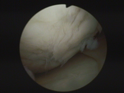 Arthroscopic image of a 45 year old patient, with clearly visible damage to the cartilage surface of a knee-joint. The surface is no longer smooth and strong, but rough and vulnerable as a result of damage.