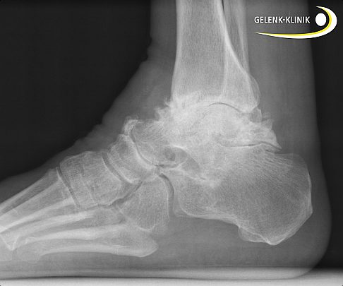 X-ray of arthritis of the ankle (lateral).