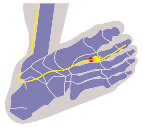 View of Morton's neuroma foot from the below