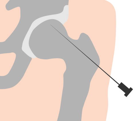 Cannula in the femoral head