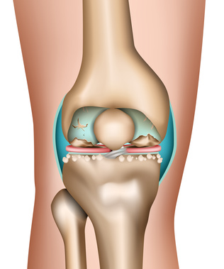 There are many causes for painful worn cartilage in the knee joint. 