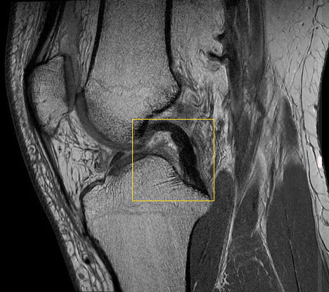 MRI of a knee with intact posterior cruciate ligament