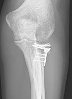 Combined screw osteosynthesis with a fixed angle plate in a patient with comminuted fracture of the radial head (Mason 3) after falling off a mountain bike. The x-ray already shows the healed situation.