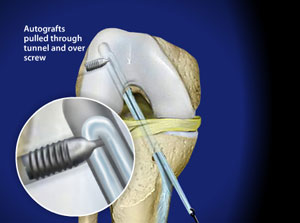 Approach to the reconstruction of the anterior cruciate ligament (ACL)