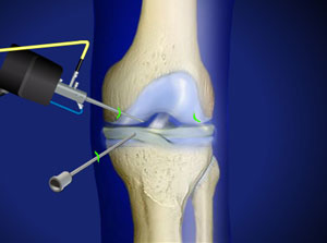 Arthroscopic knee surgery is a joint preserving therapy