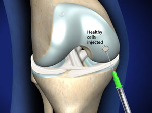 Autologous chondrocyte transplant regenerates the cartilage in the knee joint