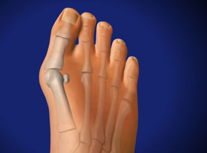 ankle realignment surgery