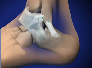 Foot specialist approach to ankle ligament reconstruction