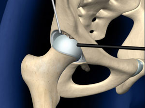 Hip specialist approach to treating osteoarthritis of the hip