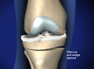 Knee realigment can prevent osteoarthritis of the knee