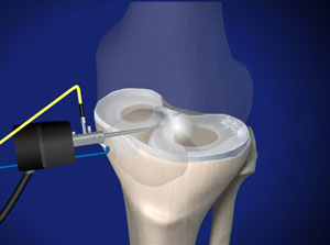 Knee specialist approach to menisc repair