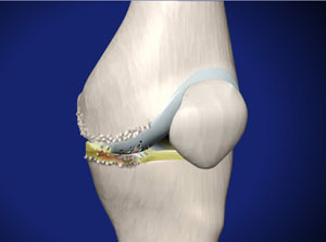 Specialist approach to osteoarthritis of the knee
