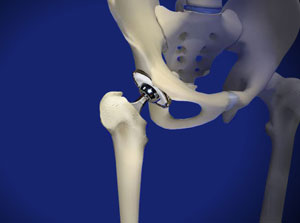 Osteoarthritis of the hip may require total hip replacement surgery