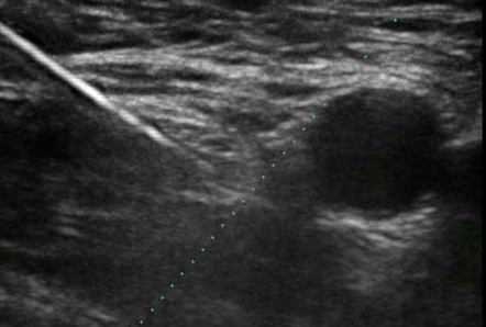 Ultrasound-guided anaesthesia can block the specific pain sensation in one arm