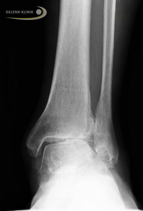 X-ray of a malunion ankle fracture