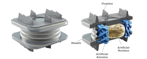 The prosthetic disc consists of a soft, shock absorbing core surrounded by an elastic mesh, which is able to  support mobility and stability in every direction. This internal structure is then enclosed in a mantle, which protects the prosthesis from the surrounding tissue. © Spinal Kinetics