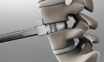 Measurement of the required height of the lumbar-disc-replacement.