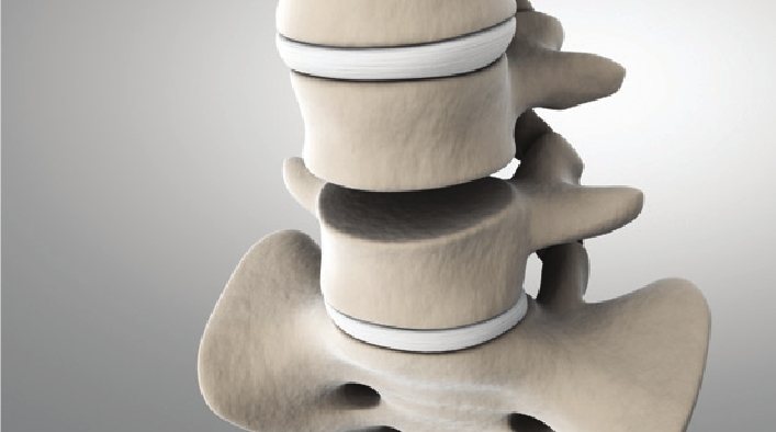 Lumbar artificial disc replacement