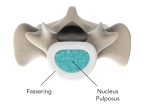 The anatomic structure of the healthy spine. The intervertebral disc is the flexible connection between two vertebral bodies.