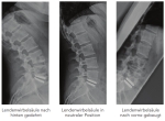 X-ray control of a M6-L disc prosthesis after transplantation