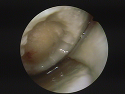 Arthroscopic Image of a 45 year old patient. Before applying new cartilage to the injured area of the joint the damaged cartilage is cleaned out via an arthroscopic procedure