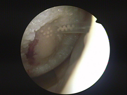 Arthroscopic Image of a 45 year old patient. The clearly visible damage to the cartilage surface of a knee-joint is covered by the regenerated cartilage graft. The graft is applied as small cartilage globuli. Once in contact with the Joint surface they will harden and form a smooth surface. After three months they will become part of the natural surface of the knee joint.