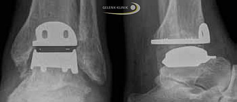 Fig. 20: Ankle prosthesis in the X-ray