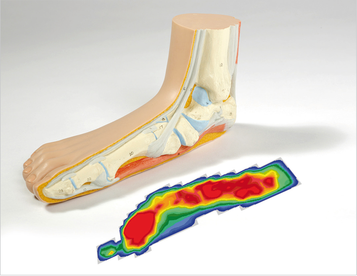 A footprint test (podometrics) of the flat valgus foot