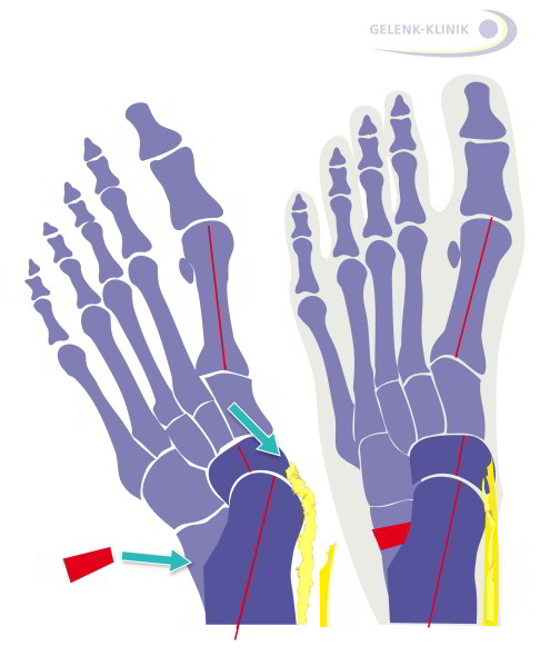 Sketch of the flat valgus foot with weakened posterior tibial tendon