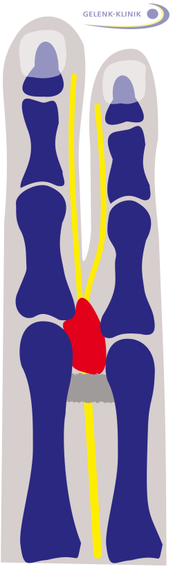 Diagram of Morton's neuroma