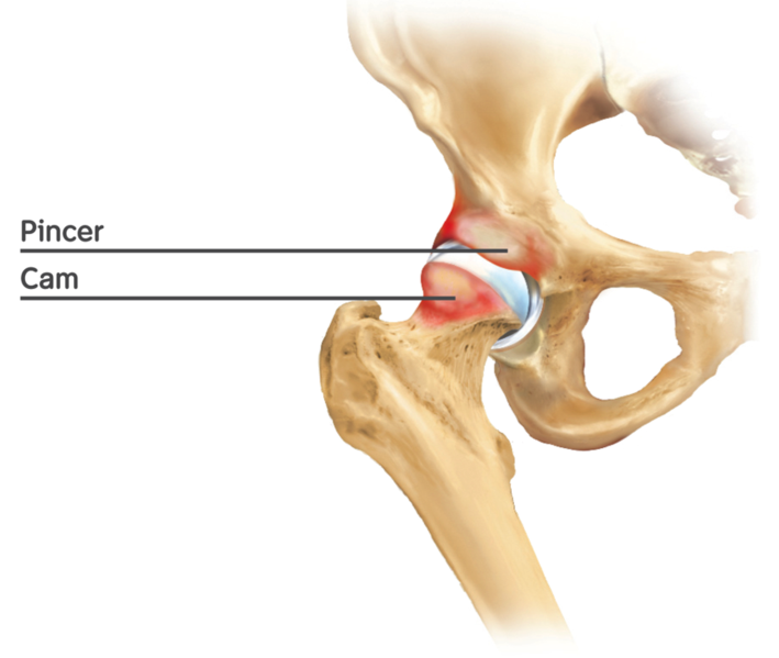 Chronic hip pain can be treated by arthroscopy of the hip