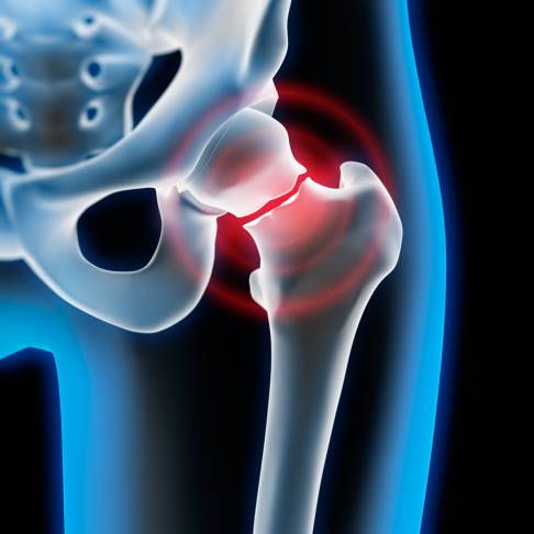 femoral neck fracture