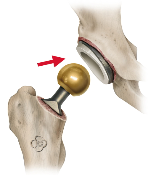 Total Hip Replacement Surgery (Hip Prosthesis) | Joint-surgeon.com