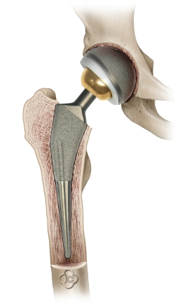 Hip Endoprothestis Saggital View