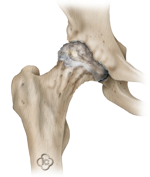 Reducing Post-Operative Pain from Hip Replacement