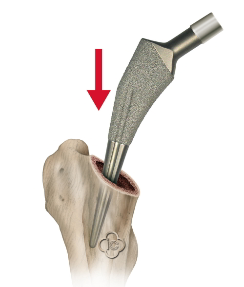 Hip Endoprothestis Ingrowing or Cemented hip stem system