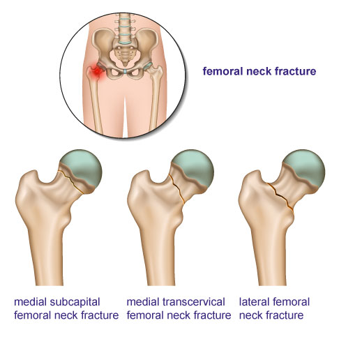 Types of femoral neck fractures