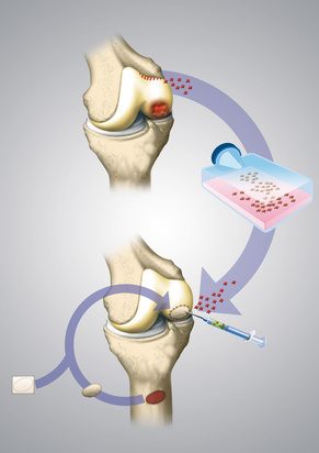 Method of cartilage transplant in the knee joint