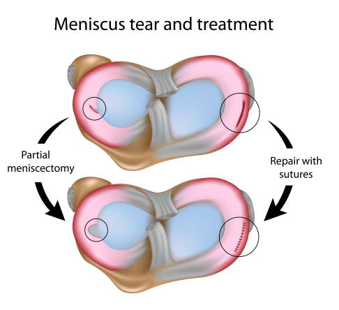 Two ways to operate a torn meniscus