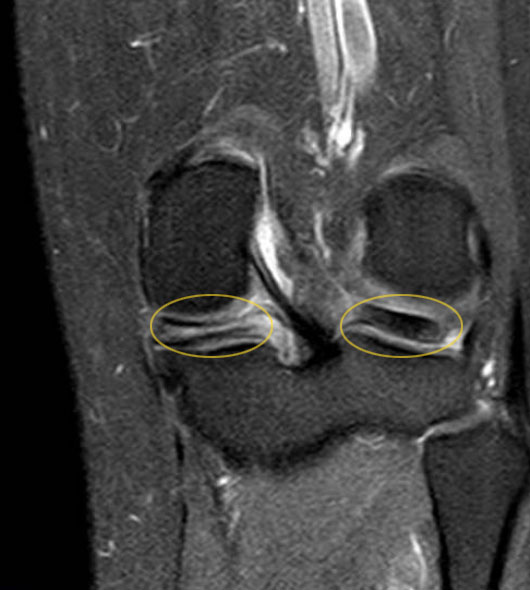 MRI: meniscus tear along the longitudinal axis