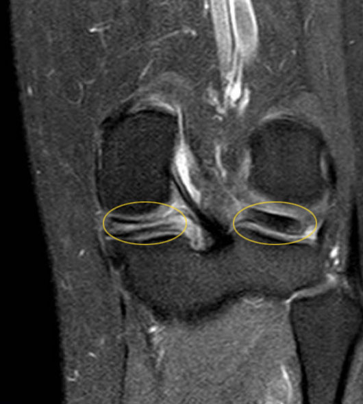 Two ways to operate a torn meniscus