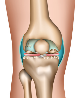 repair knee cartilage naturally