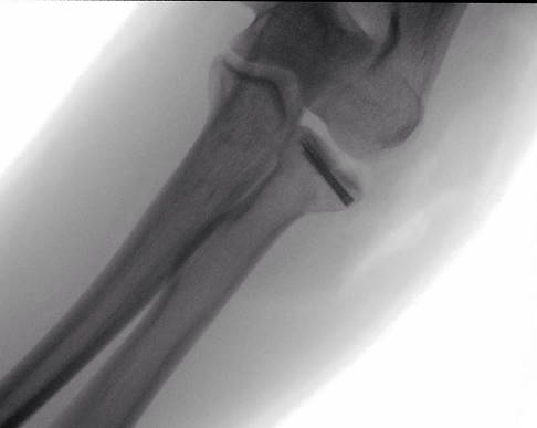 The radial head fracture was treated with screws and plates (osteosynthesis).