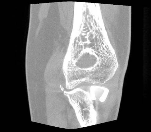 Overstuffing of a radial head prosthesis