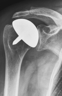 CAP® shoulder resurfacing or shoulder hemiarthroplasty