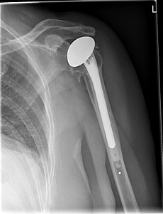 Total shoulder replacement or total shoulder arthroplasty